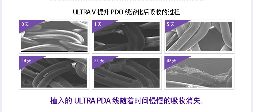 ULTRA V提升PDO线溶化后吸收的过程 0 天, 1 天, 5 天, 14 天, 21 天, 42 天 植入的ULTRA PDA 线随着时间慢慢的吸收消失。