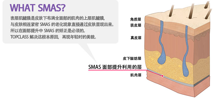 WHAT  SMAS？ 表层肌腱膜是皮肤下布满全面部的肌肉的上层肌腱膜，与皮肤相连紧密SMAS的老化现象直接通过皮肤显现出来。所以在面部提升中SMAS的矫正是必须的。TOPCLASS解决这根本原因，再现年轻时的美貌。