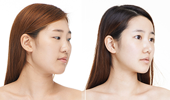 Jaw Recontouring, Angle Reduction, V-Line Face - Tes Clinic for Face and Jaw
