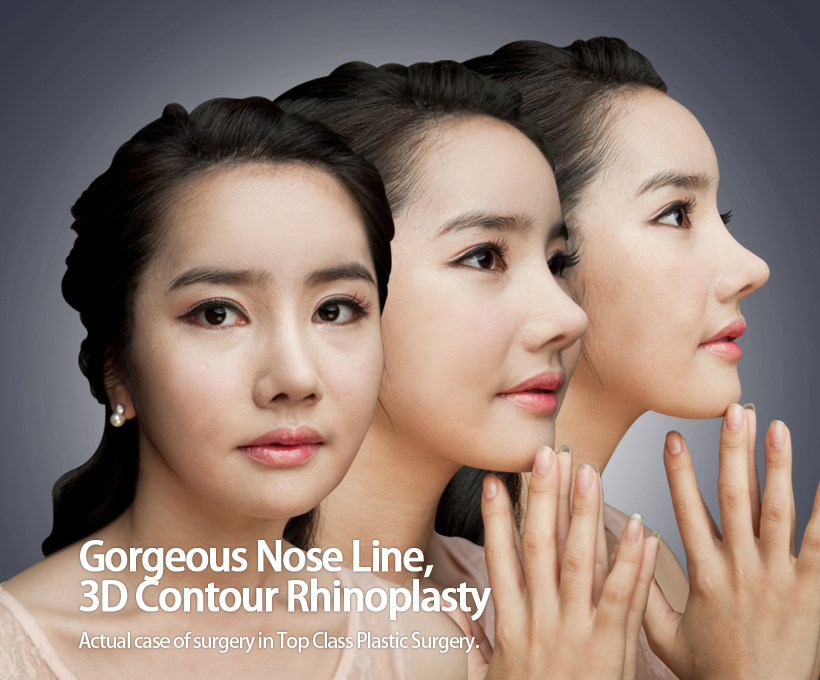 Gorgeous Nose Line,  3D Contour Rhinoplasty Actual case of surgery in Top Class Plastic Surgery. 
