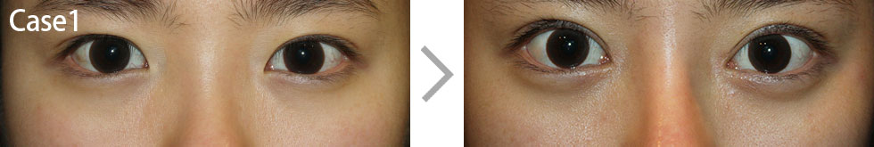 Case1 Non-incisional Ptosis Surgery Before/After