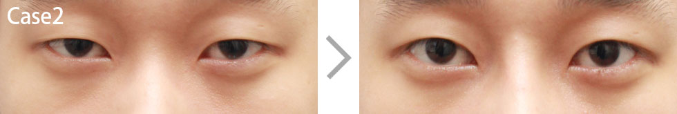 Case2 Non-incisional Ptosis Surgery Before/After