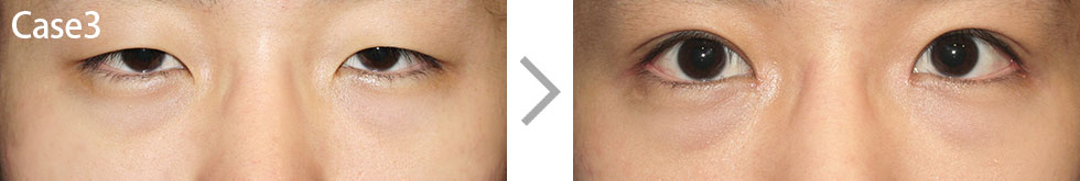 Case3 Non-incisional Ptosis Surgery Before/After