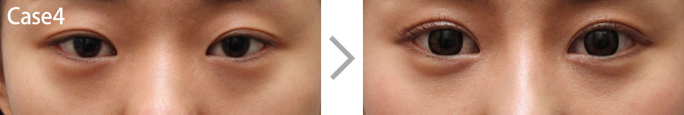 Case4 Non-incisional Ptosis Surgery Before/After