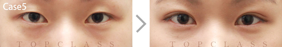 Case5 Non-incisional Ptosis Surgery Before/After