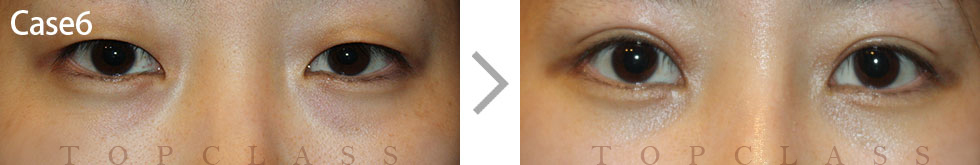Case6 Non-incisional Ptosis Surgery Before/After