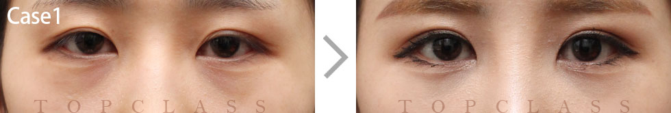Case1 Incisional Ptosis Surgery Before/After