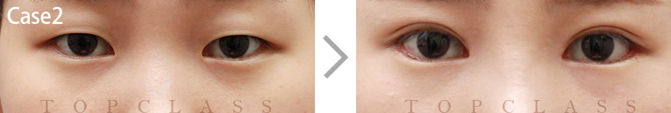 Case2 Incisional Ptosis Surgery Before/After
