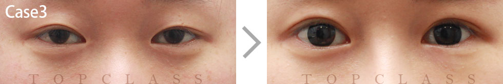 Case3 Incisional Ptosis Surgery Before/After