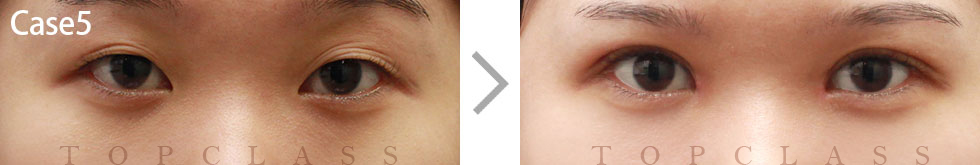 Case5 Incisional Ptosis Surgery Before/After