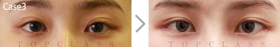 Case3 Revisional Double Eyelid Surgery Before/After