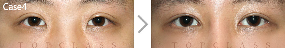 Case4 Revisional Double Eyelid Surgery Before/After