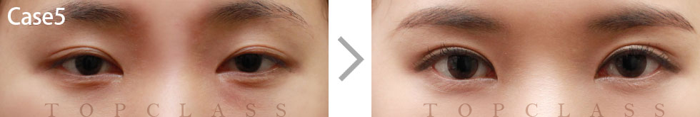Case5 Revisional Double Eyelid Surgery Before/After