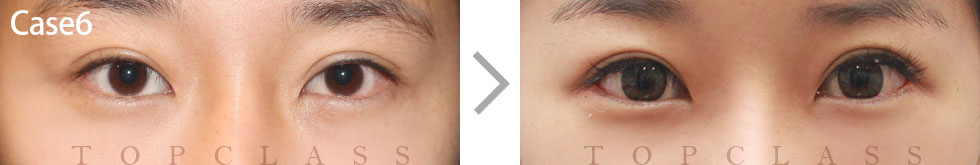 Case6 Revisional Double Eyelid Surgery Before/After
