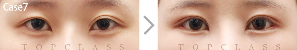 Case7 Revisional Double Eyelid Surgery Before/After
