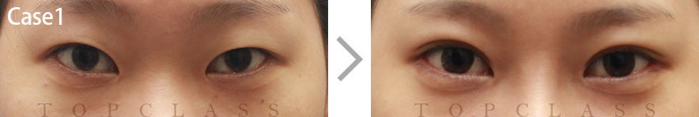 Case1 Natural Adhesion Double Eyelid Technique Before/After