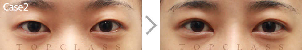Case2 Natural Adhesion Double Eyelid Technique Before/After