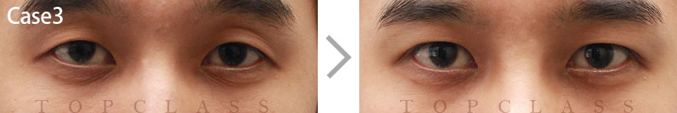 Case3 Natural Adhesion Double Eyelid Technique Before/After