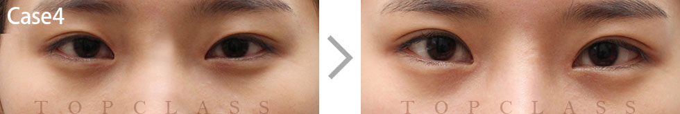 Case4 Natural Adhesion Double Eyelid Technique Before/After