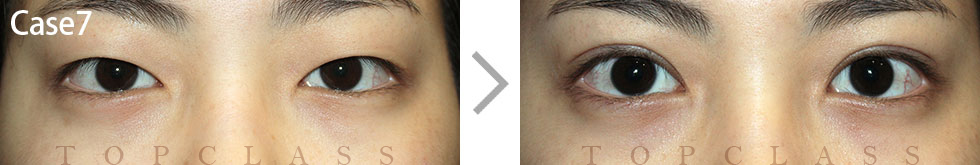 Case7 Natural Adhesion Double Eyelid Technique Before/After