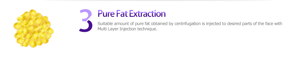 3 Pure Fat Extraction, Suitable amount of pure fat obtained by centrifugation is injected to desired parts of the face with Multi Layer Injection. 