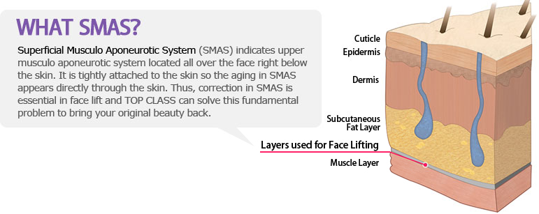 WHAT  SMAS？ Superficial Musculo Aponeurotic System (SMAS) indicates upper musculo aponeurotic system located all over the face right below the skin. It is tightly attached to the skin so the aging in SMAS appears directly through the skin. Thus, correction in SMAS is essential in face lift and TOP CLASS can solve this fundamental problem to bring your original beauty back.
